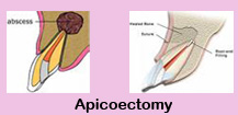 Dental surgeons India,Root canal therapy