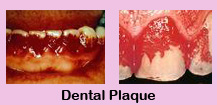 Cheap Dental Treatment,Cheap Dental Treatment India