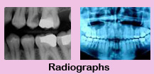 Root canal therapy,Root canal therapy India