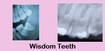 Root canal therapy,Root canal therapy India,Teeth whitening,Teeth whitening India